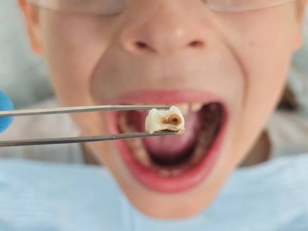 Best Emergency Root Canal Treatment in Albion, NE